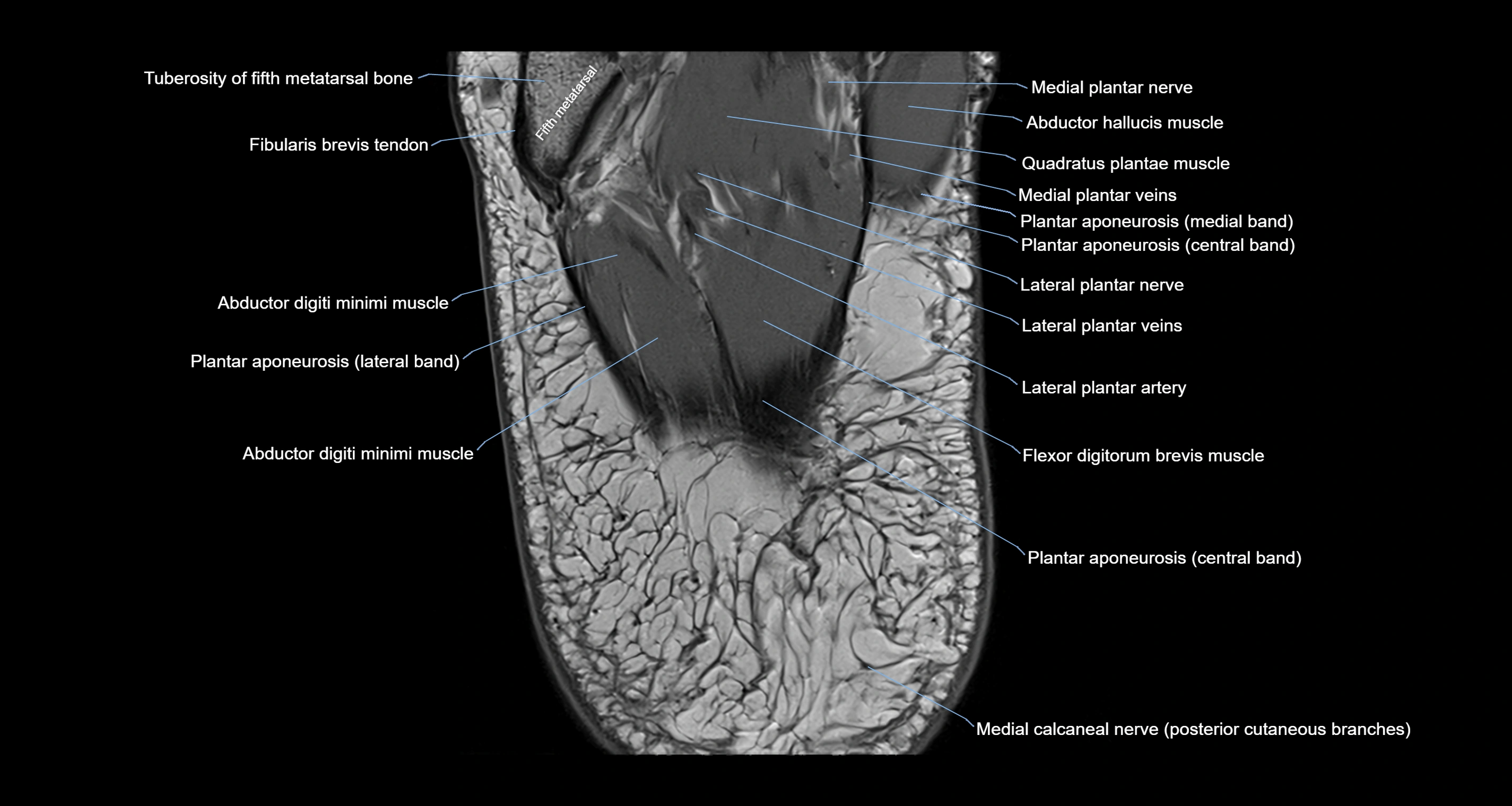 Ankle axial anatomy 3T MRI images -img-10001-00040.webp